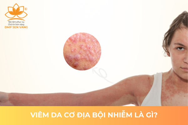 Viêm Da Cơ Địa Bội Nhiễm Là Gì? 
